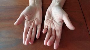 Онемение пальцев рук и ног после химиотерапии: что делать, лечение
