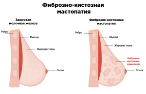 Кистозная мастопатия: лечение, симптомы, чем опасна, виды