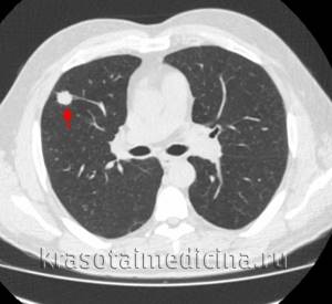 Периферический рак лёгкого: первые симптомы, стадии, причины, диагностика и лечение