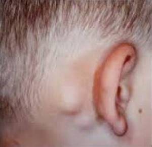 Лимфоузел за ухом: фото, причины воспаления, расположение, симптомами каких болезней является увеличение