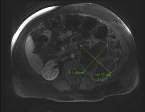 Светлоклеточный рак почки: прогнозы после удаления, симптомы и лечение