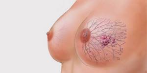 Инвазивный рак молочной железы: типы, симптомы, прогноз и лечение