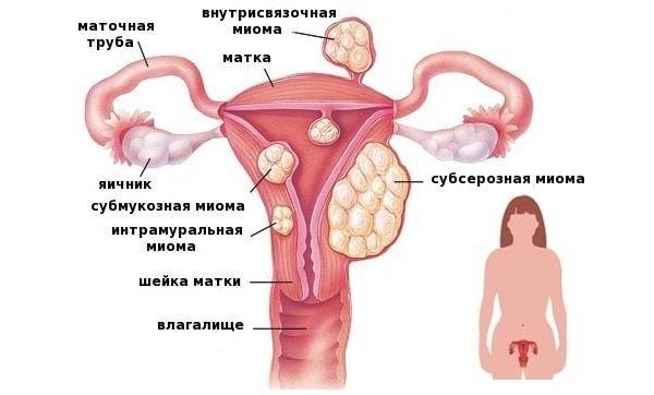Интрамуральная лейомиома матки: что это такое, лечение, показания к операции