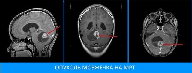 Опухоль мозжечка: симптомы, операция по удалению, прогноз и последствия