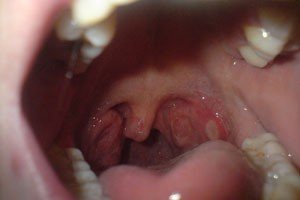 Рак горла: симптомы, фото на ранних стадиях