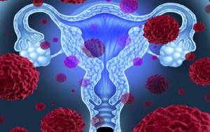 Инвазивный рак шейки матки: виды, прогноз, симптомы и лечение