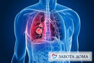 Рак лёгких 4 стадии: сколько живут, симптомы перед смертью, методы лечения