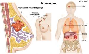 Метастазы рака молочной железы: куда метастазирует, симптомы и лечение