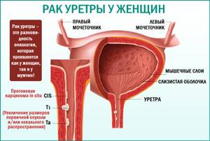 Рак уретры: симптомы, причины, лечение, диагностика и особенность протекания у мужчин и женщин