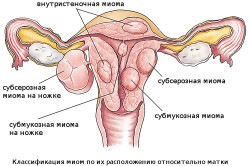Удаление миомы матки: размеры для операции, методы и последствия