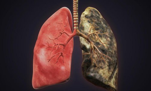 Рак лёгких 2 стадии: прогноз жизни, лечение, симптомы и виды