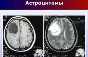 Астроцитома головного мозга: анапластическая, пилоцитарная, фибрилярная и диффузная