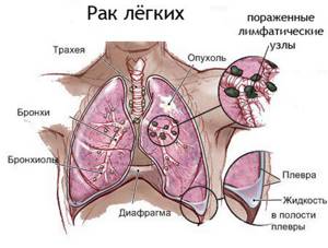 Центральный рак лёгкого: стадии, симптомы, прогноз, диагностика и лечение