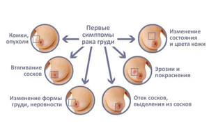 Фиброзная мастопатия: лечение, симптомы, причины и диагностика