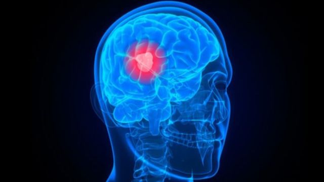 Лимфома головного мозга: симптомы, лечение и прогноз
