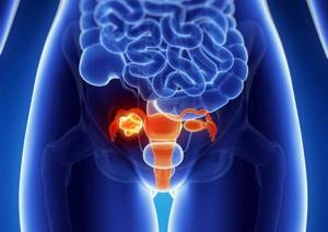 Рак шейки матки 4 стадии: продолжительность жизни, симптомы, прогноз выздоровления и распространения метастазов