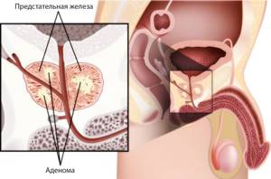 Аденокарцинома предстательной железы: баллы по Глисону, симптомы, прогноз и лечение