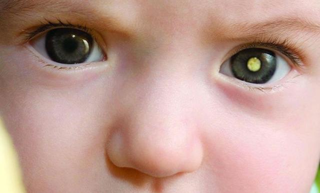 Опухоль глаза: симптомы, лечение и классификация