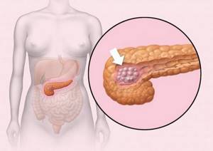 Липоматоз поджелудочной железы: лечение, диета, степени и прогноз продолжительности жизни
