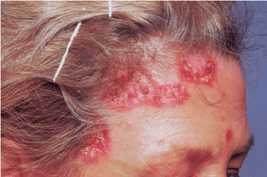 Саркоидоз кожи: фото, симптомы, лечение и диагностика