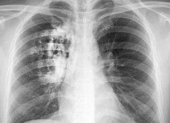 Рак лёгких: симптомы на ранних стадиях, причины, лечение, виды и прогноз