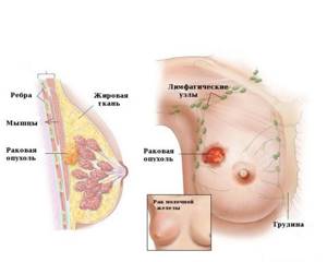 Рак молочной железы 1 стадии: прогноз выживаемости, симптомы, лечение и фото