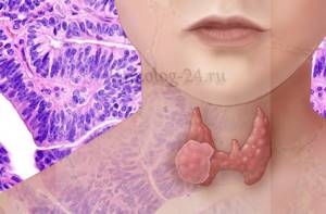 Фолликулярный рак щитовидной железы: прогноз после операции, симптомы, лечение и диагностика