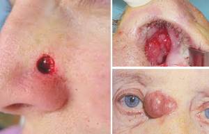 Рак носа: симптомы, лечение при первых признаках и начальной стадии