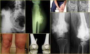 Остеохондрома: симптомы, операция по удалению и последствия