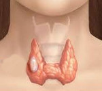 Медуллярный рак щитовидной железы: симптомы, прогноз, лечение, стадии и диагностика