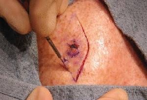 Удаление базалиомы: хирургическим путём, лазером и лечение после операции