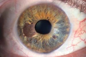 Рак глаза: симптомы, фото, причины, лечение и стадии