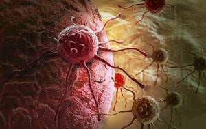 Низкодифференцированный рак желудка: прогноз, симптомы и лечение