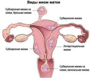 Субмукозная лейомиома матки: что это такое, опасность, лечение и операция