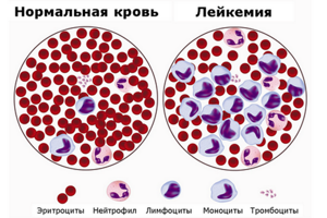 Рак крови: симптомы, сколько живут, методы лечения, стадии и диагностика