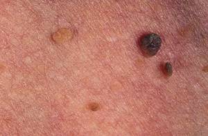 Фибропапиллома: симптомы, удаление на коже и десне, причины, лечение