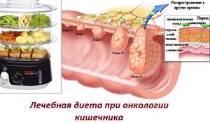 Питание при раке кишечника: диета до и после операции, во время химиотерапии