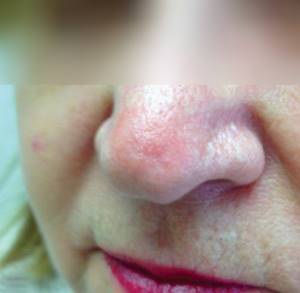 Базалиома на носу: фото, облучение, признаки и лечение