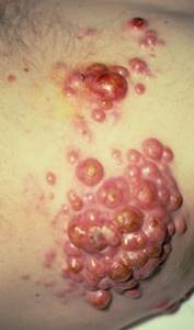 Лимфома кожи: фото, симптомы и лечение