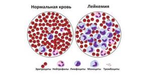 Анализ крови при лейкозе: показатели у взрослых и детей