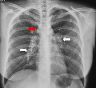 Липома в лёгких: чем опасна, симптомы и лечение