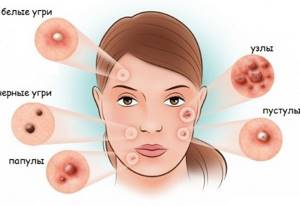 Фотодинамическая терапия: метод лечения в онкологии, косметологии и гинекологии, побочные эффекты