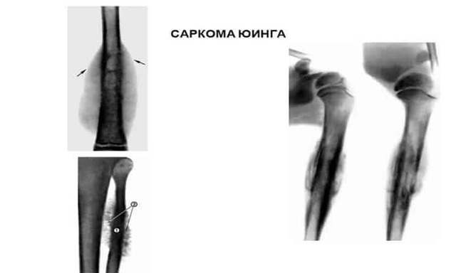 Саркома Юинга: симптомы, фото, прогноз выживаемости и лечение