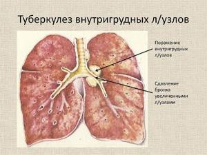 Туберкулёз лимфоузлов: симптомы, лечение, заразен или нет, диагностика