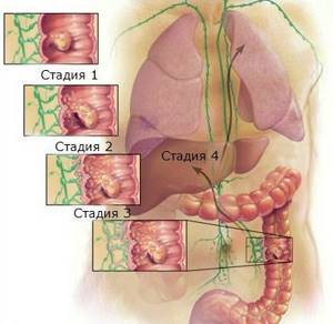 Рак ободочной кишки: первые симптомы, стадии, операция, диагностика и лечение