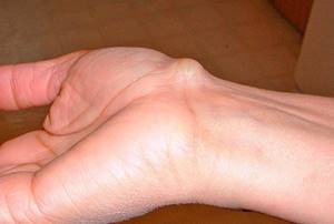 Жировик на руке под кожей: причины, фото, как избавиться