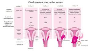 Рак шейки матки 4 стадии: продолжительность жизни, симптомы, прогноз выздоровления и распространения метастазов