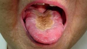 Рак языка: фото начальной стадии, симптомы, прогноз и лечение