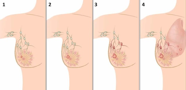 Рак груди 3 стадии: прогноз выживаемости, лечение, симптомы, необходимость операции