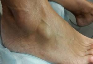 Жировик на ноге: фото, причины и быстрое лечение